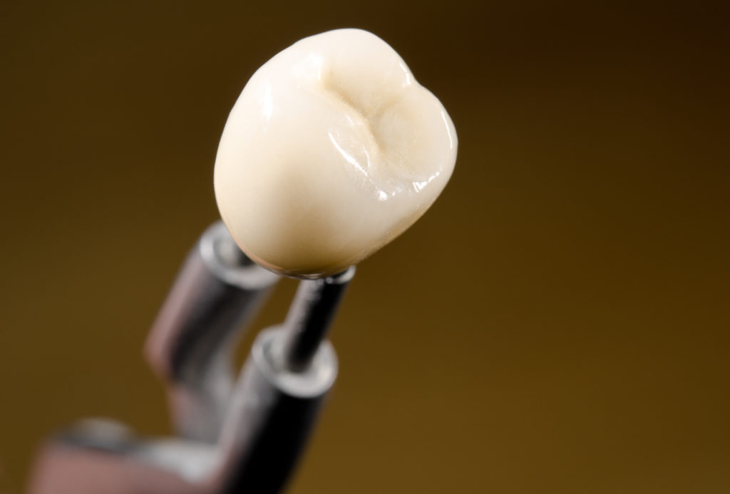 Особенности протезирования 6 и 7 зубов