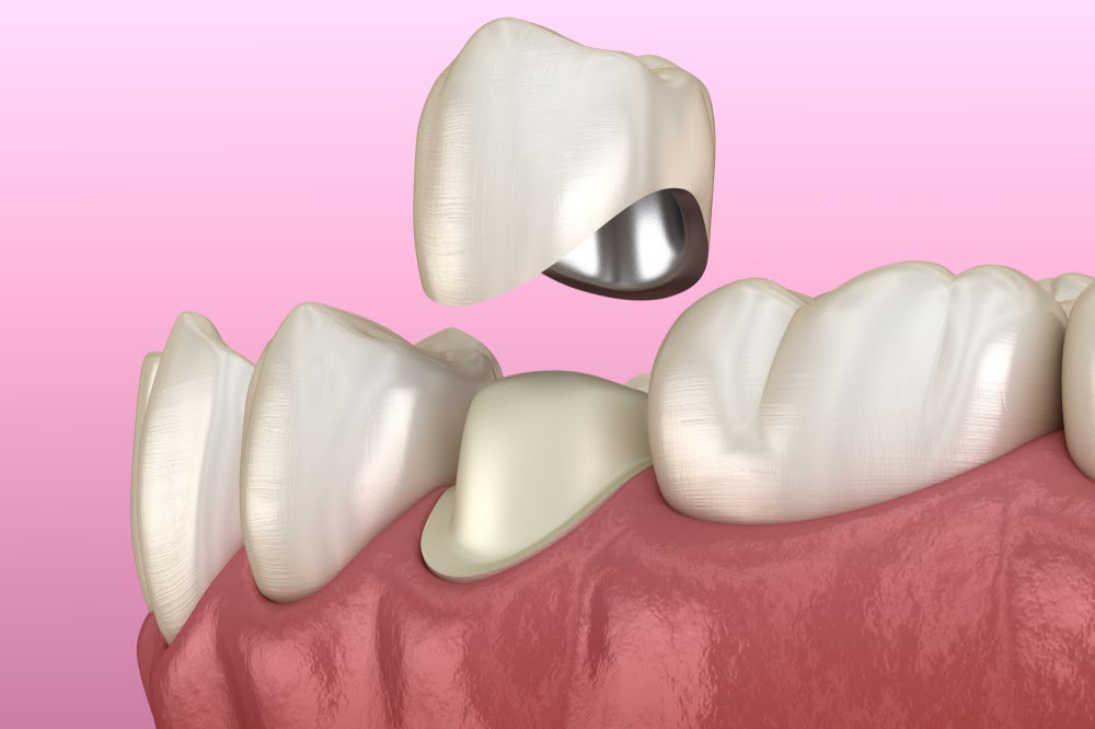 лечение зубов при булимии