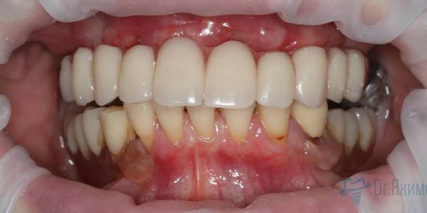 Вид временного протеза в полости рта