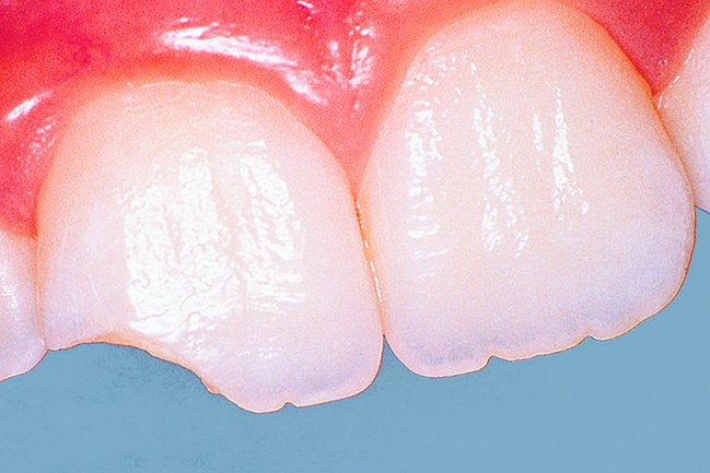 Скол зуба: что делать при травме?