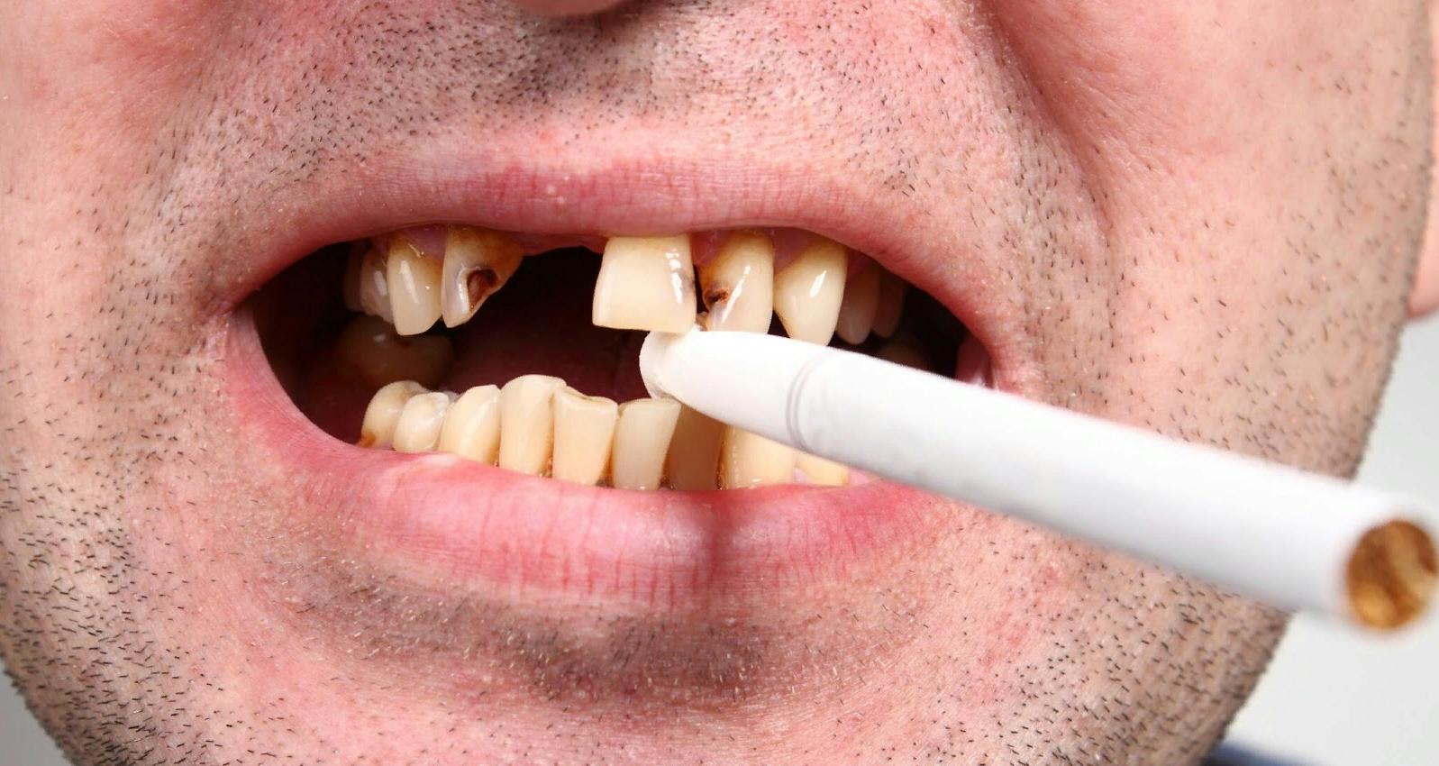 Пятна на зубах: почему появляются, как убрать