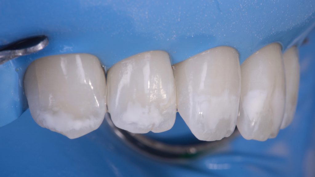 Белые пятна на зубах: причины. Как от них избавиться?