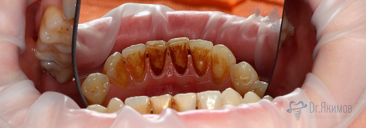 Состояние зубов до процедуры профгигиены