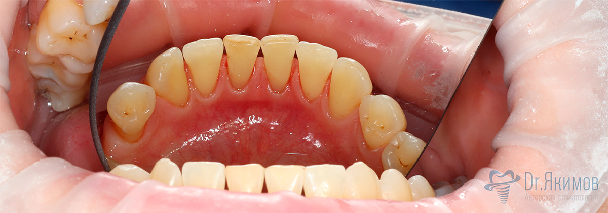 Состояние зубов после процедуры профгигиены