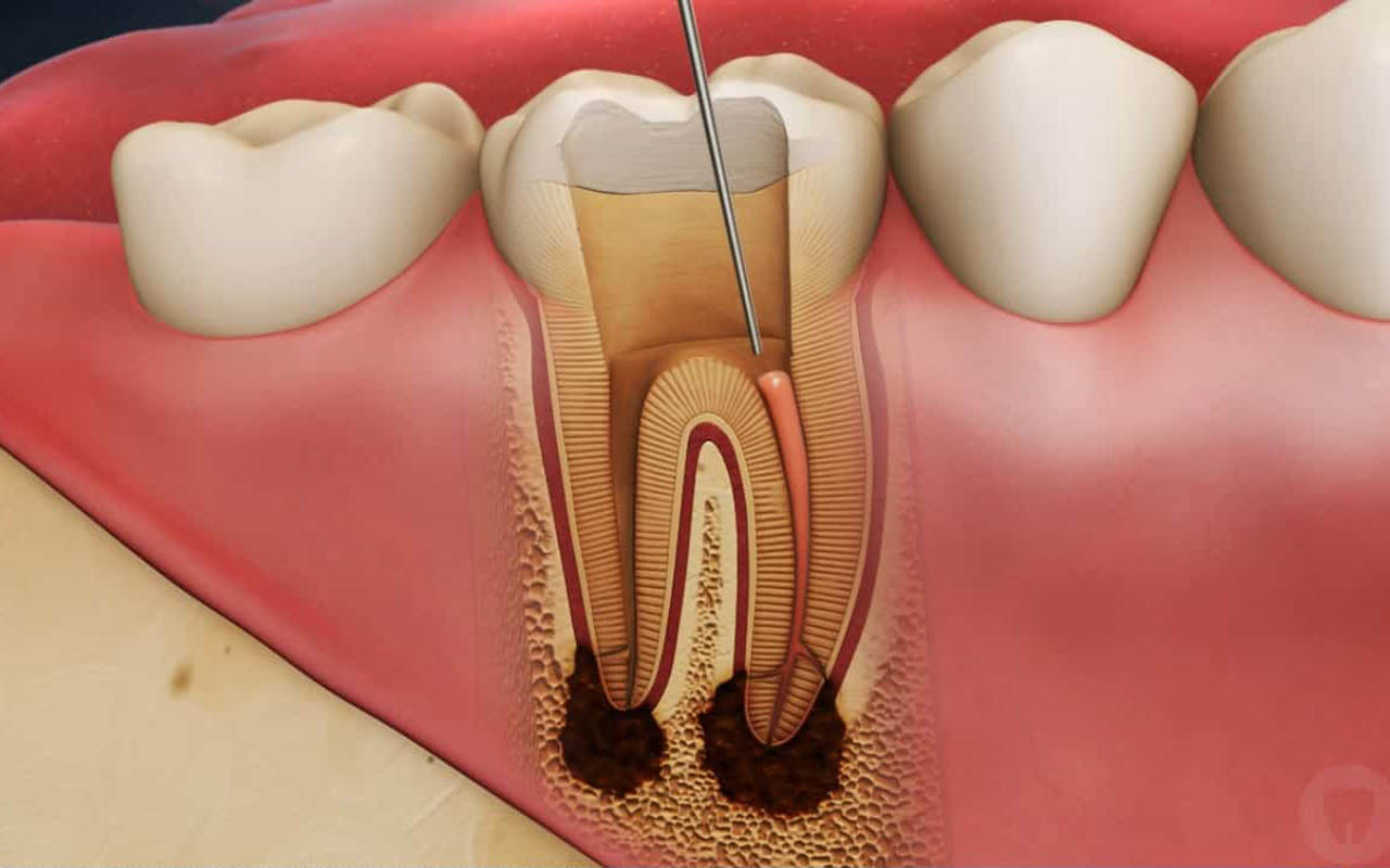 Обширный пульпит зуба: что это и как лечить?