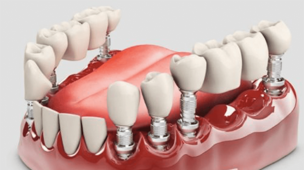Какие снимки нужны для имплантации зуба?