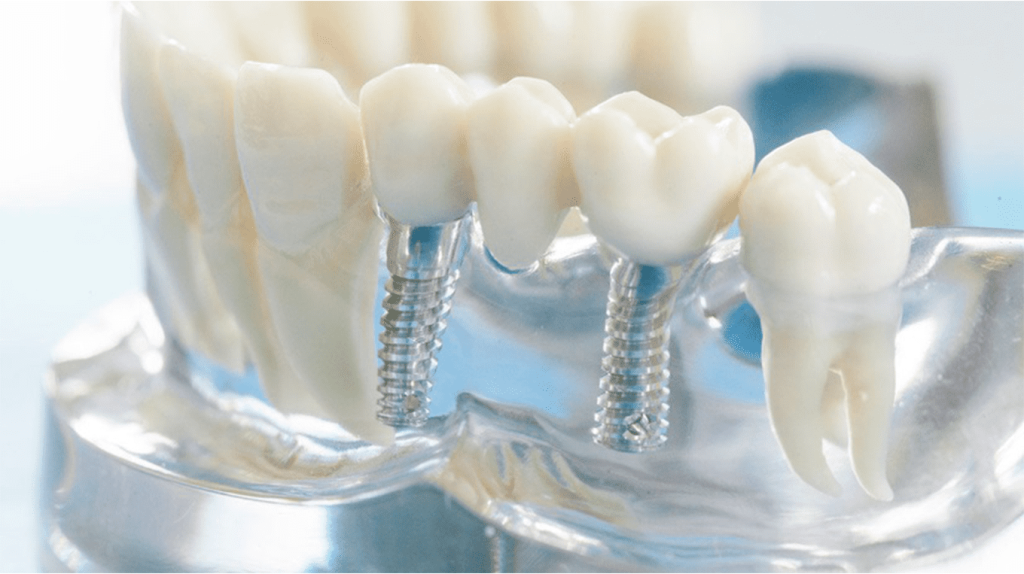 Какие последствия могут быть после имплантации зуба?
