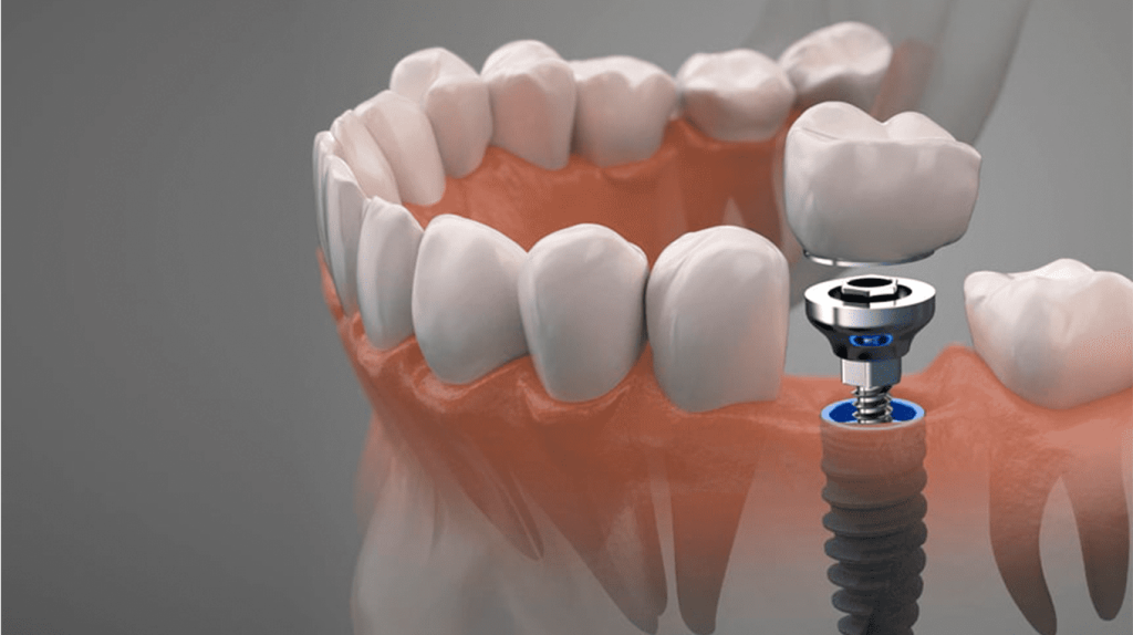 Какой врач занимается имплантацией зубов в стоматологии?