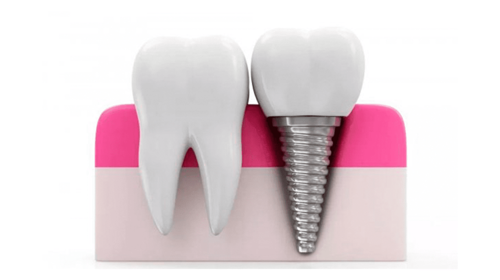 Порядок имплантации зубов